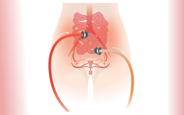 Peritoneal Cancer Surgery with HIPEC